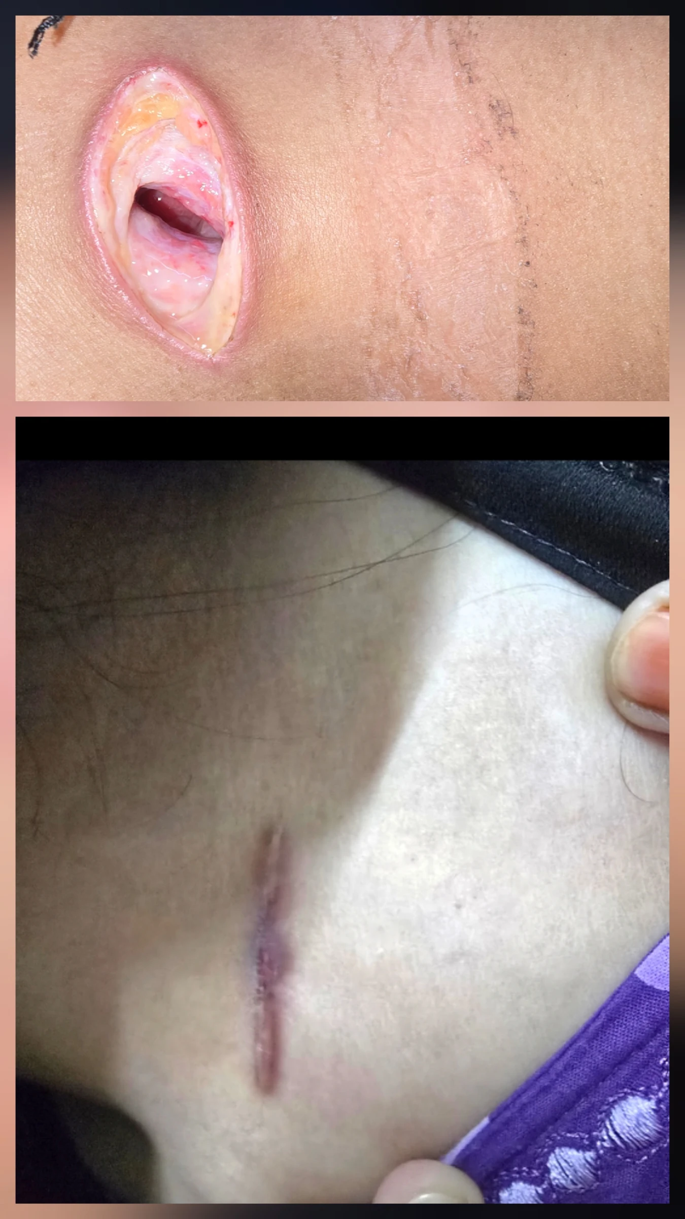 Healed supraclavicular wound after drainage of an abscess and secondary-intention healing.
