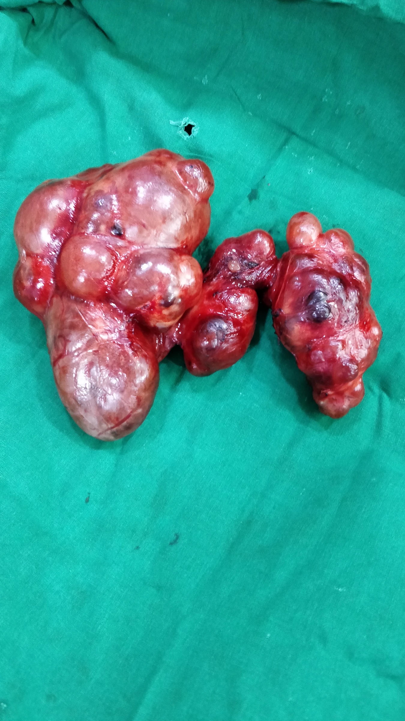 Surgical specimen after total thyroidectomy for multinodular goitre involving both thyroid lobes.