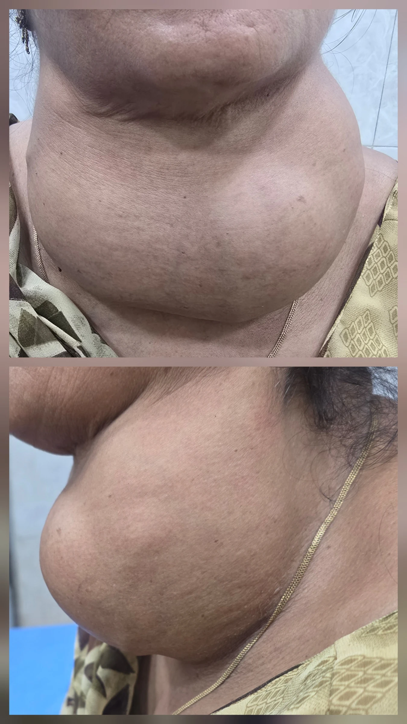 Large neck swelling from goitre causing compression of the trachea.