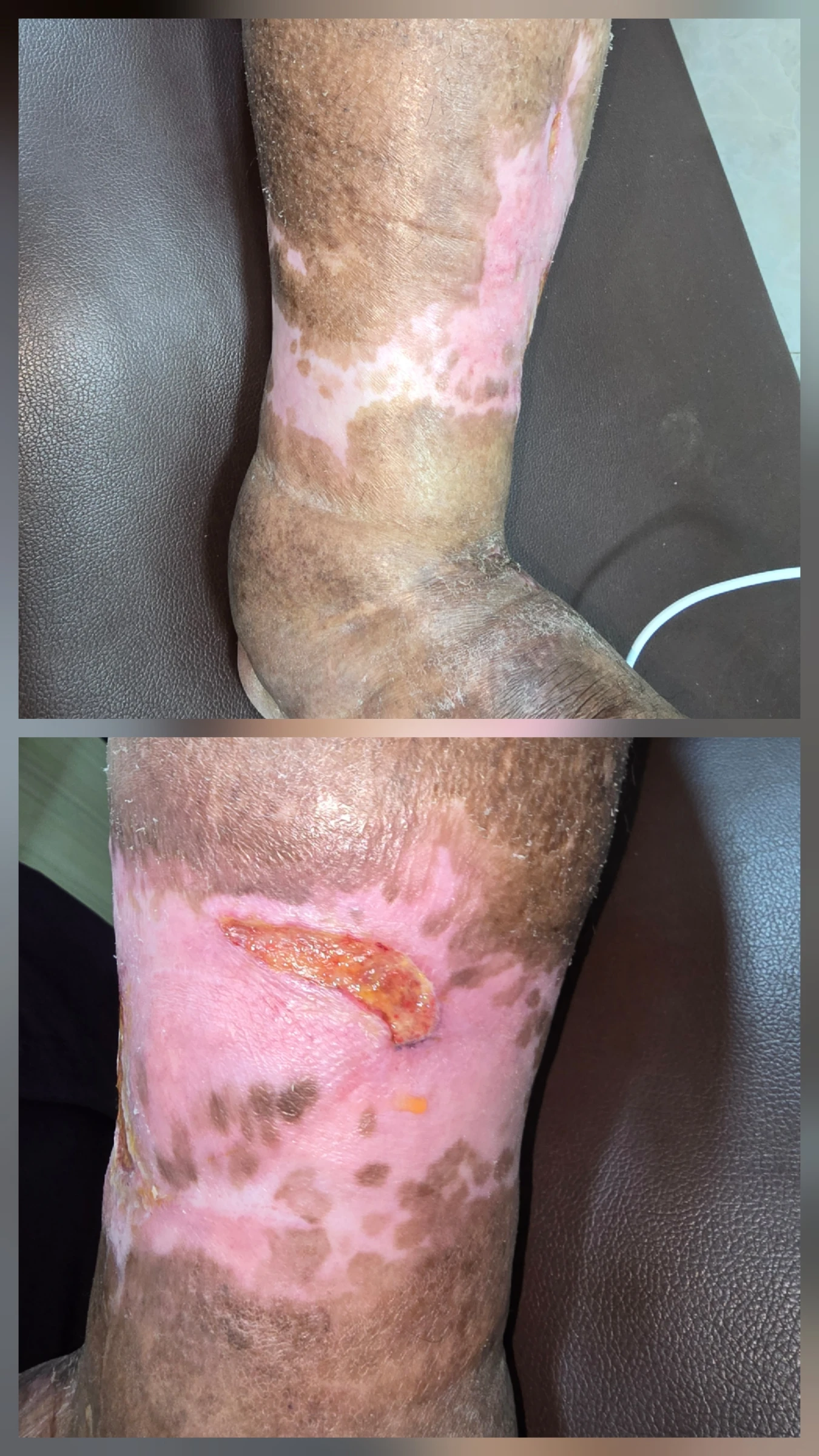 Same chronic lower-limb wound after three months of compression therapy, showing substantial healing.